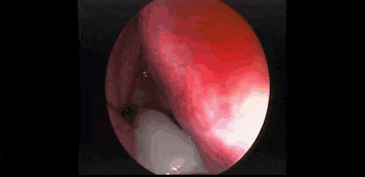 [혐주의] 콧속에 있는 거대 콧물 덩어리 석션으로 꺼내는 짤.gif27