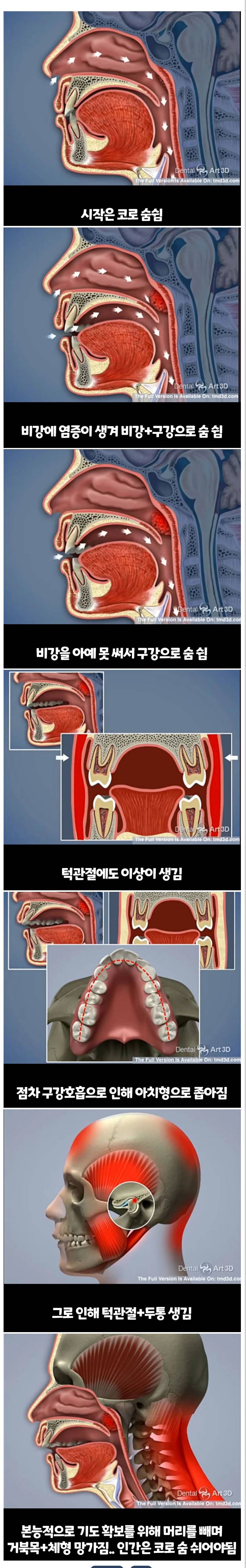비염의 무서움.jpg6